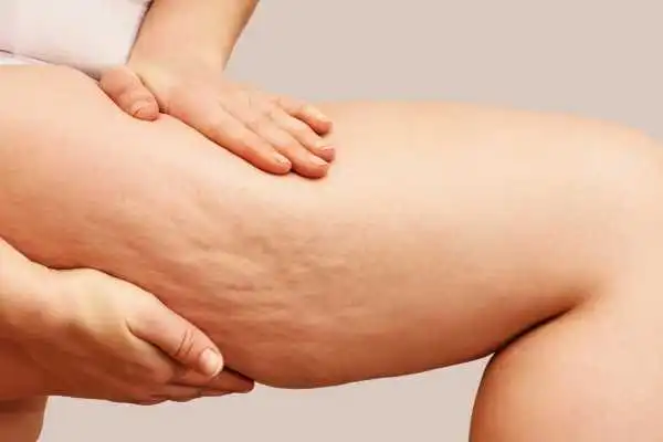 Image of woman showing leg with cellulite Burnt Tree