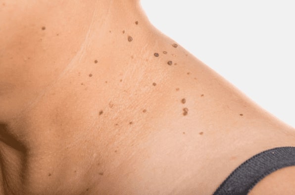 Are you looking for easy skin tag removal Burnt Tree - then contact Spire today!