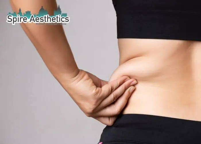 Image of woman pinching fat on their hips Burnt Tree. Fat Freezing treatment