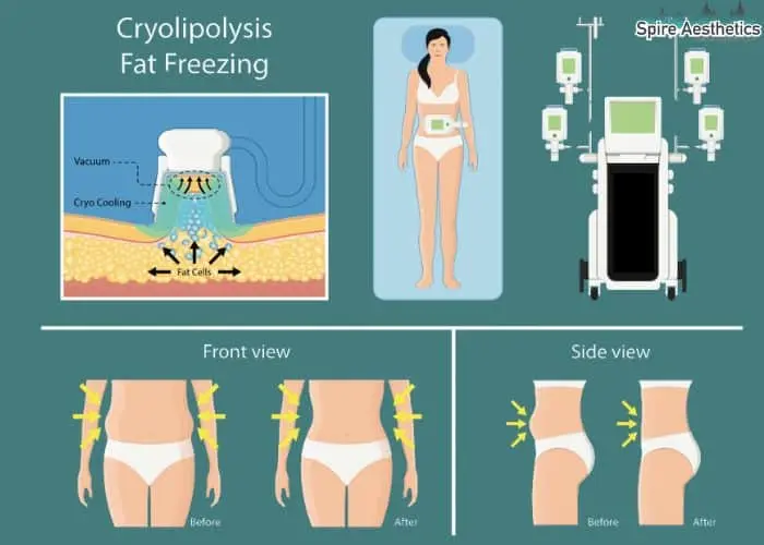 Fat freezing treatment Burnt Tree benefits for competitions to remove stubborn fat deposits.