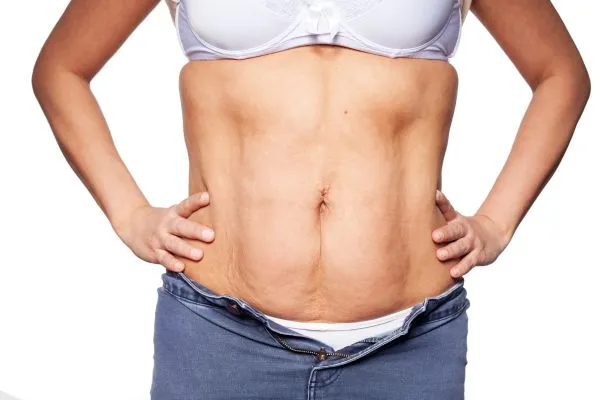 sagging skin on woman's stomach after weight loss injections Burnt Tree